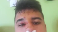 Da li su ovo povrede od udarca loptom u lice?, Pionirska liga RS, Istok - Liga za prvaka